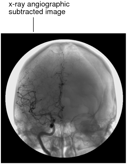 X-ray angiographic subtracted image